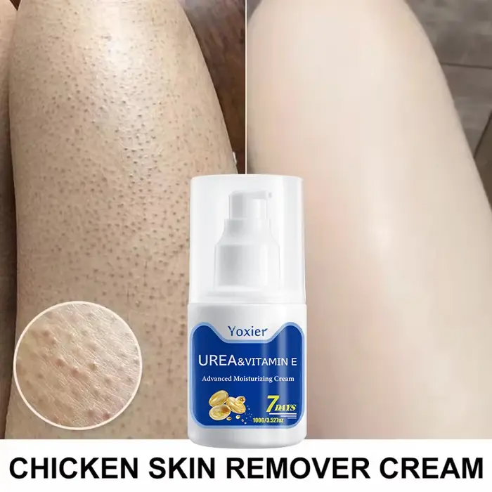 Crème d'élimination de la peau de poulet, 100g, réparation du corps, kératose Pilaris, taches de por