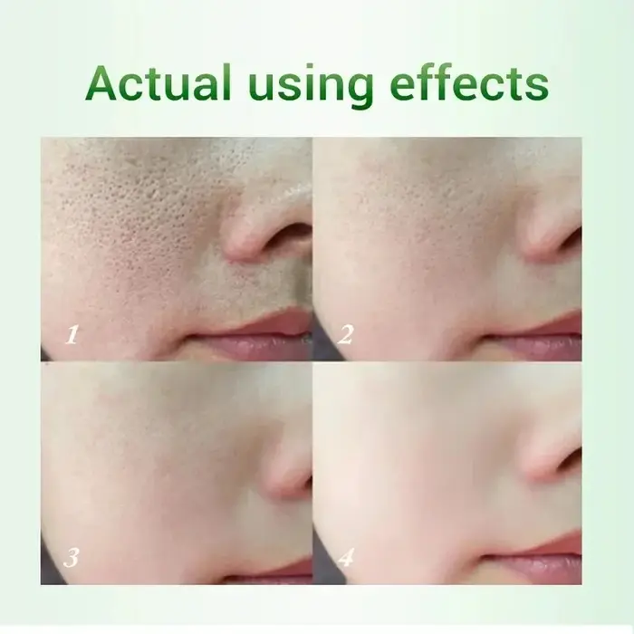 Crème de rétrécissement des pores à l'acide salicVAC
