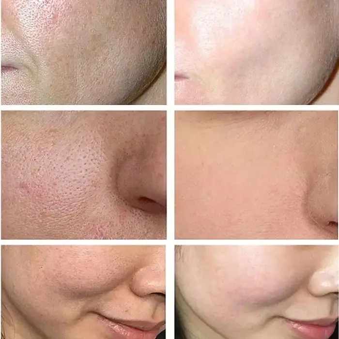 Crème de traitement à l'acide salicylique pour resserrer les pores
