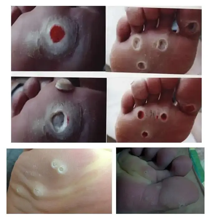 30 pièces/ensemble orteils et pieds protecteurs coussinets callosités