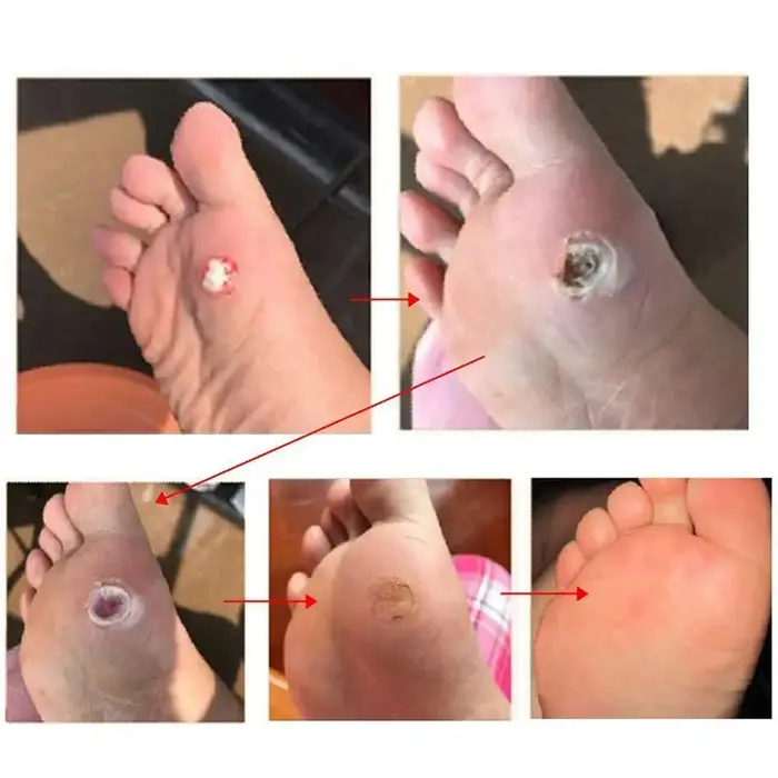 30 pièces/ensemble orteils et pieds protecteurs coussinets callosités