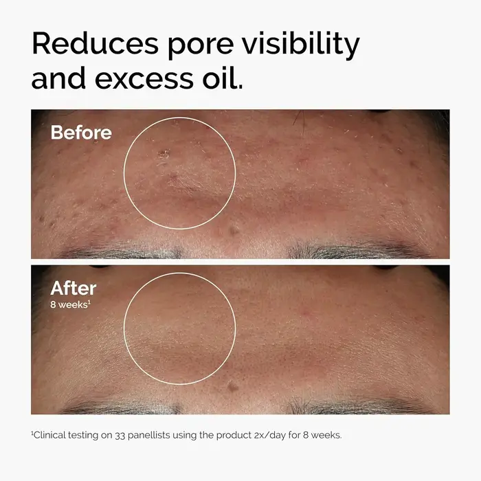 Sérum pour le visage à 10% de niacinamide et 1% de zinc