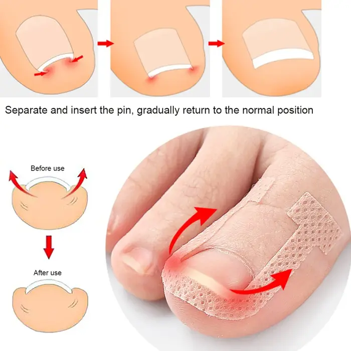 Autocollants de traitement des ongles incarnés