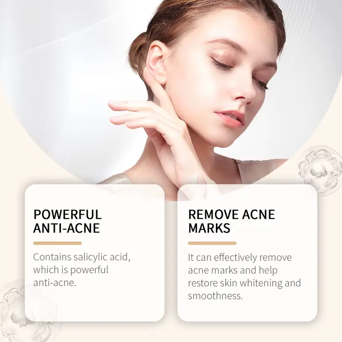 Calendula crème à l'acné Anti-acné et marques de décoloration contrôle du sébum rétrécissement des Pores