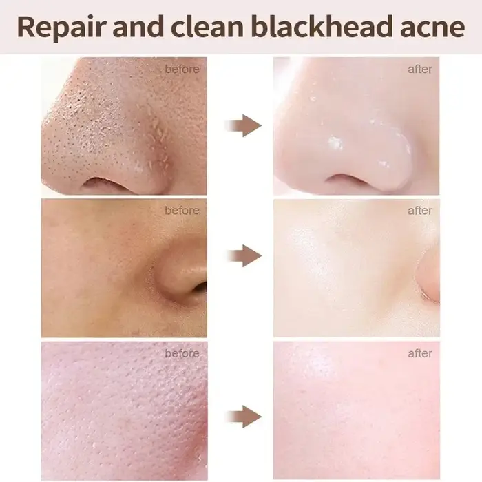 Crème de rétrécissement des pores à l'acide salicVAC