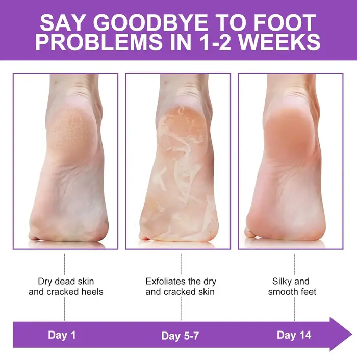 Chaussettes exfoliantes pour les pieds