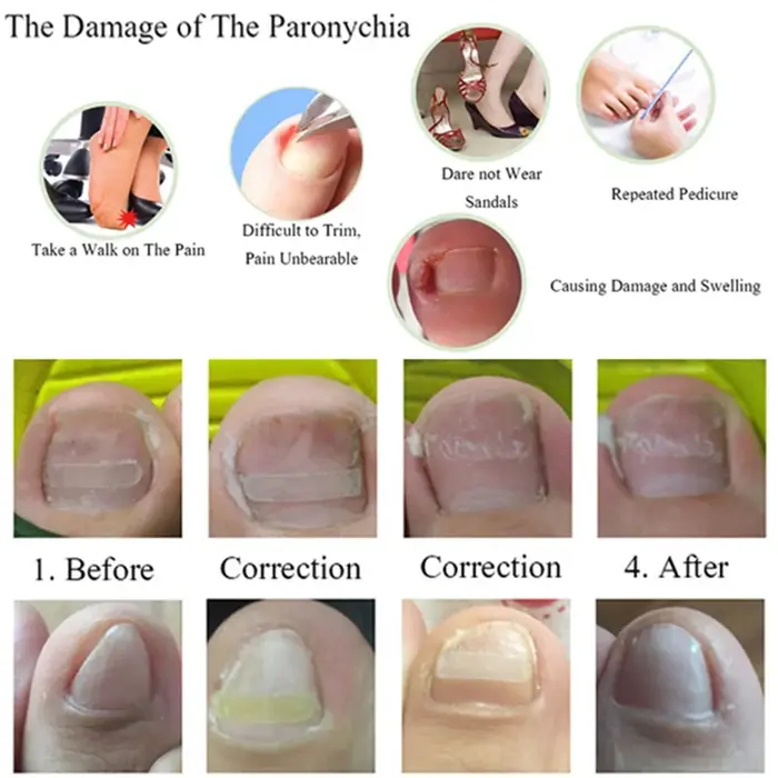 Traitement des ongles incarnés 10-100X
