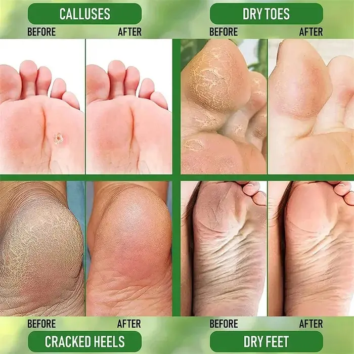 Crème Anti-fissure à base de plantes pour les pieds