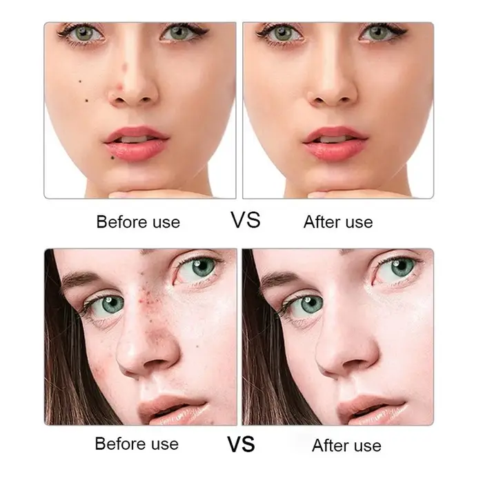 Stylo Laser Plasma, stylo cosmétique
