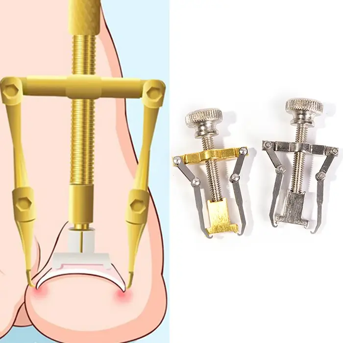 Correction professionnelle des ongles incarnés