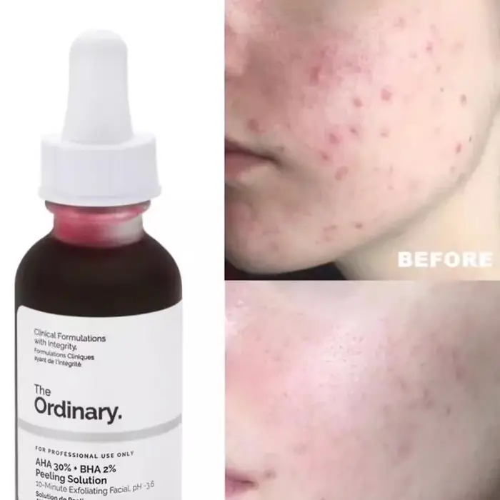 AHA 30% + BHA 2% Solution Peeling 30ml