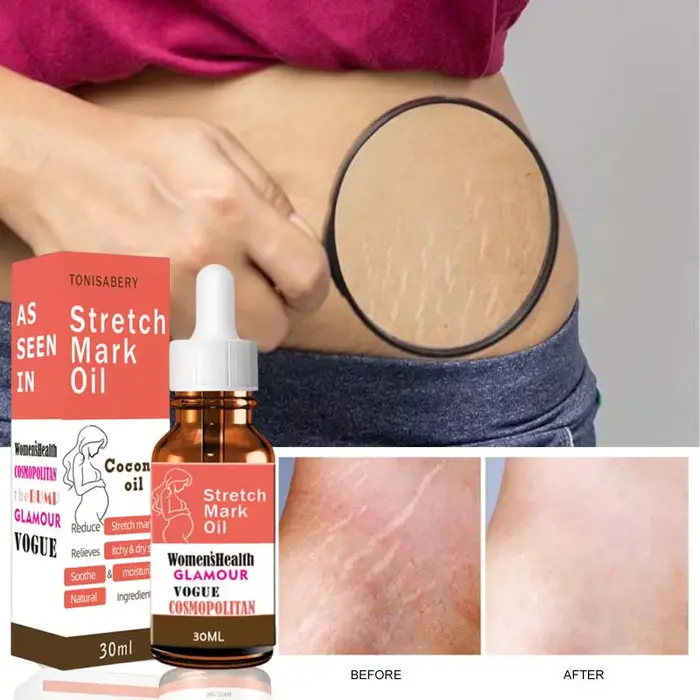 Sérum réparateur de vergetures pour femmes enceintes