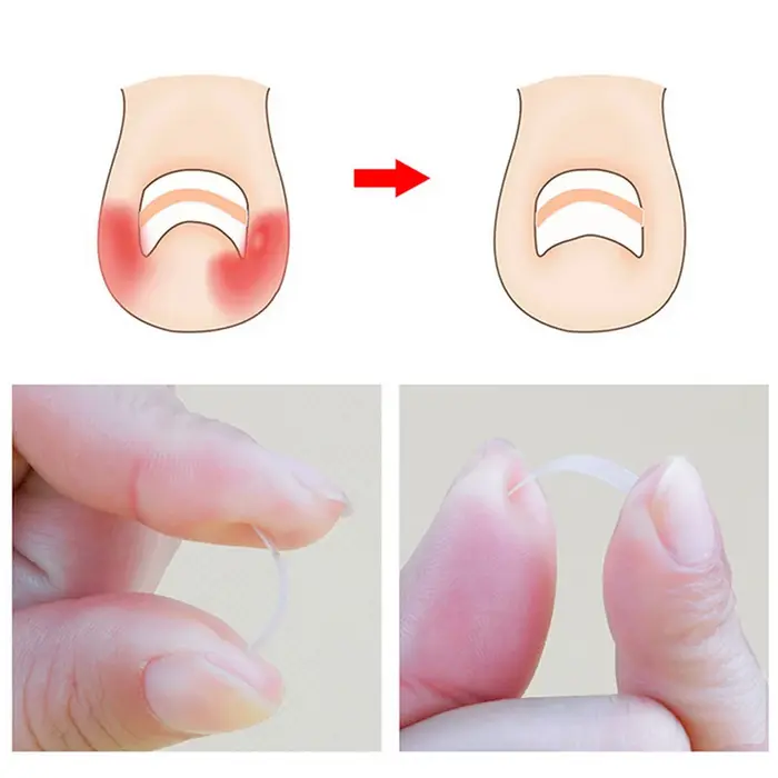 Traitement des ongles incarnés 10-100X