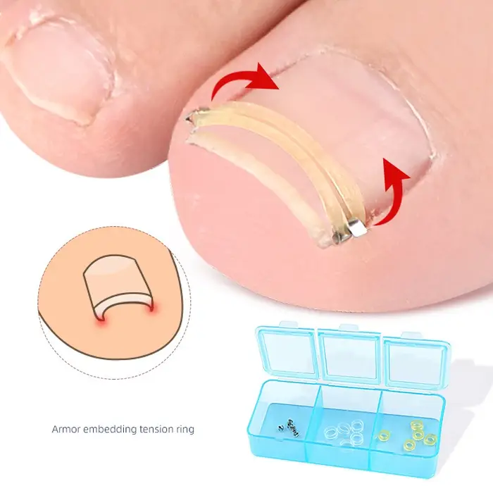 Correcteur d'ongles incarnés